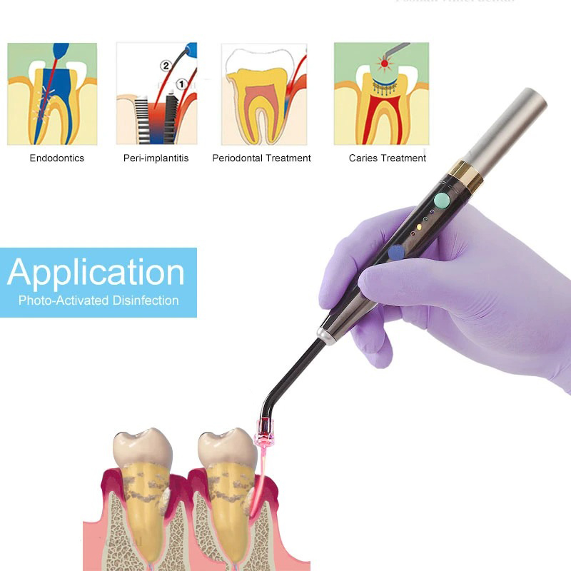 ระบบเลเซอร์ไดโอดทันตกรรมไร้สาย - Diode Laser Module บทวิจารณ์และราคา